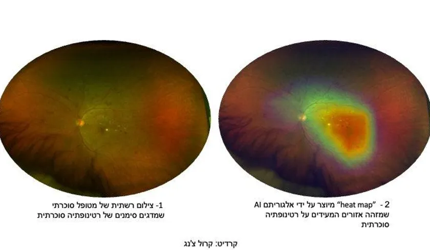 השוואת צילום רשתית ומפת חום לזיהוי רטינופתיה סוכרתית